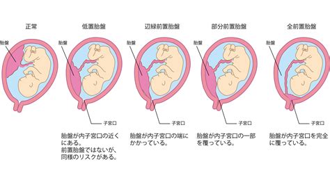 低位胎盤|低置胎盤の原因、症状、妊娠や胎児への影響 治療や予防は可。